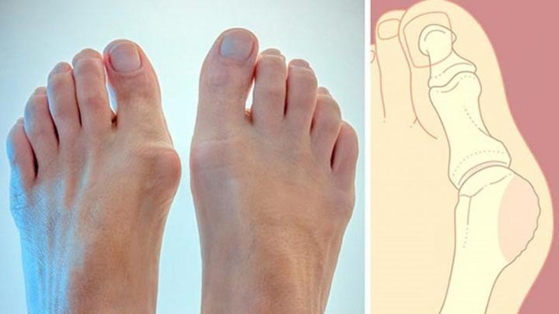 'Tovonda suyak o`simtasi qanday paydo bo`ladi?'ning rasmi