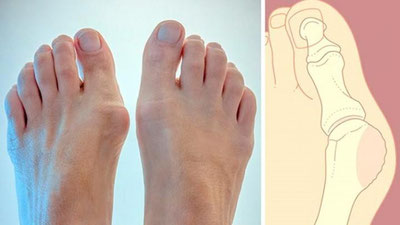 'Tovonda suyak o`simtasi qanday paydo bo`ladi?'ning rasmi