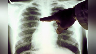 'JSST tuberkulyozdan o`lim ko`rsatkichi nega oshib ketayotganining sababini ma`lum qildi'ning rasmi