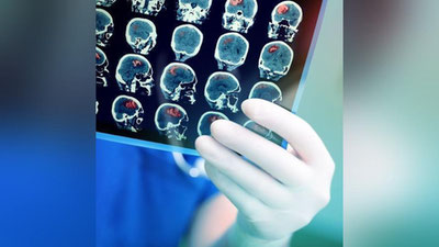 'Saraton kasalligini aniqlashning yangi usuli topildi'ning rasmi