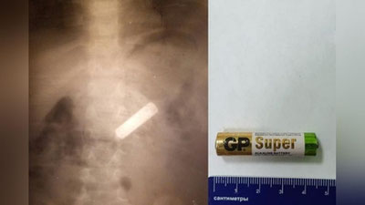 'Rossiyada o`zbekistonlik qizcha batareyka yutib yuborib vafot etdi'ning rasmi