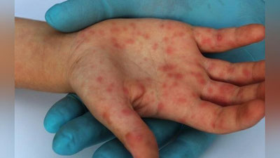 'ЖССТ қизамиққа қарши шошилинч эмланишга чақирмоқда'ning rasmi