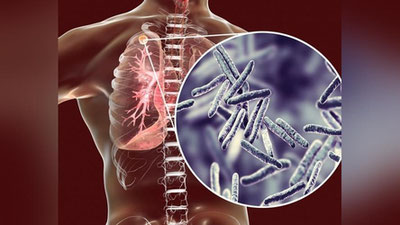 'Сил касаллигининг даволаш муддатини 6 ойдан 4 ойга қисқартиш мумкин – ЖССТ'ning rasmi