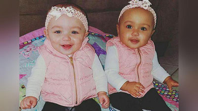 '​AQShda tanasining rangi ikki xil bo`lgan egizaklar tug`ildi'ning rasmi