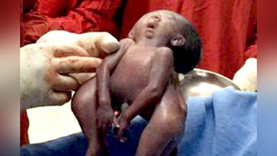 Изрображение 'В Индии родились сиамские близнецы с одним лицом на двоих'