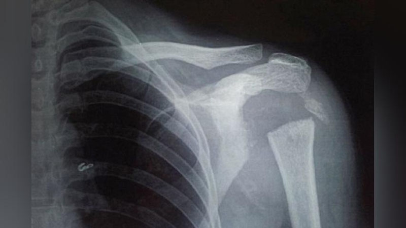 'Kam uchraydigan kasallik tufayli hind ayolining qo`li 180 darajaga aylanadigan bo`lib qoldi'ning rasmi