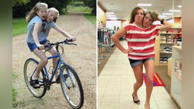 '28 yoshli Siam egizaklari qanday kun ko`rishadi? (Foto)'ning rasmi