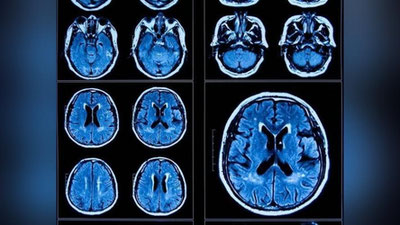 'COVIDning og`ir ko`rinishi inson miyasini qaritishi mumkin'ning rasmi