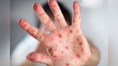 'Qozog`istonda qizamiqdan ikki bola vafot etdi'ning rasmi