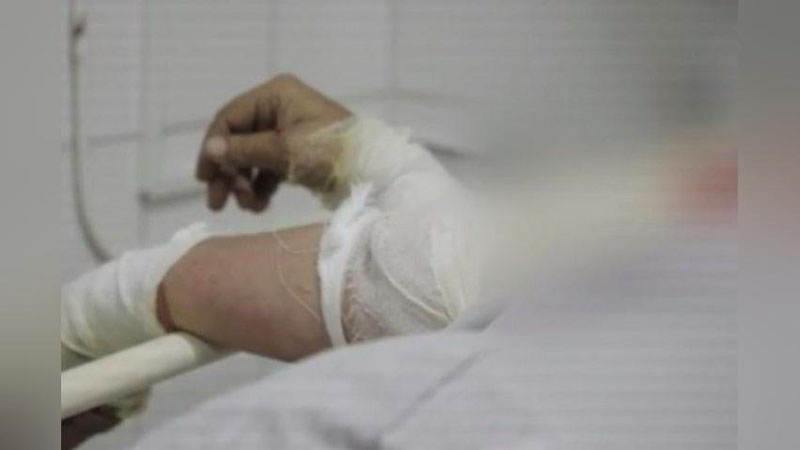 'Quyi Chirchiqda 15 yoshli bolaning tanasi 90 foiz kuyib ketdi'ning rasmi