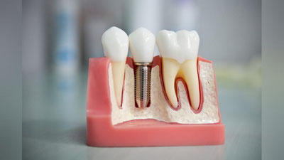 'Tish implantasiyasi qanchalik foydali? Mutaxassis javob berdi'ning rasmi