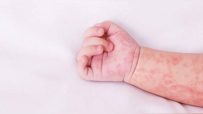 'Markaziy Osiyoda qizamiq bilan kasallanish 3000 foizga oshdi'ning rasmi