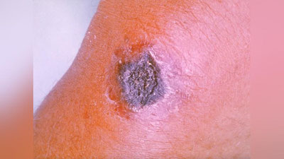 'Qozog`iston shimolida kuydirgi epidemiyasi qayd etildi'ning rasmi