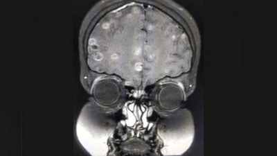 'Yuvilmagan mevalarni iste`mol qilgan qizchaning miyasiga yuzlab gijjalar o`rnashib oldi'ning rasmi