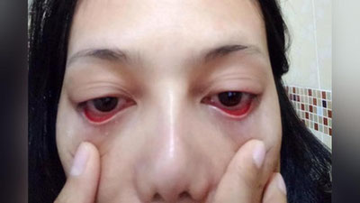 'Tailandlik ayol superelim tufayli kipriklaridan ayrildi 'ning rasmi