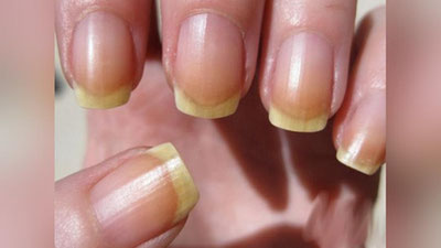 'СИНУВЧАН, НОТЕКИС ВА ҚОРАЙГАН ТИРНОҚЛАР... 6 САВОЛГА-ЖАВОБ! 'ning rasmi