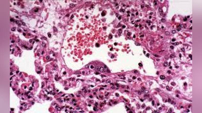 'Hindistonda grippga o`xshash yangi vurs aniqlandi'ning rasmi