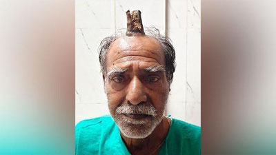 Изрображение 'Жителю Индии удалили рог на голове'