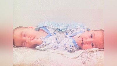 'O`zbekiston tibbiyot tarixida ilk bor siam egizaklari operasiya natijasida ajratib olindi'ning rasmi