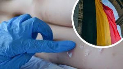 'Бельгия маймунчечак касаллигига қарши карантин жорий этган дунёдаги биринчи давлат бўлди'ning rasmi