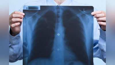 'Yana 497 nafar kishida pnevmoniya aniqlandi'ning rasmi