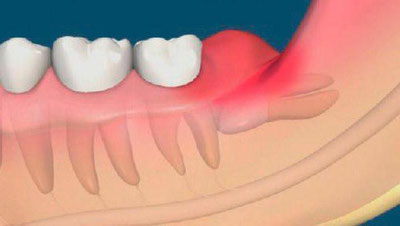'​“Ақл” тишни олдириш шартми?'ning rasmi