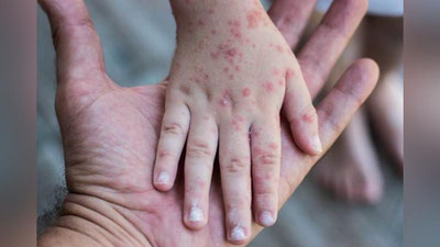 'ЖССТ маймунчечак кўпроқ кимларга хавф туғдиришини маълум қилди'ning rasmi