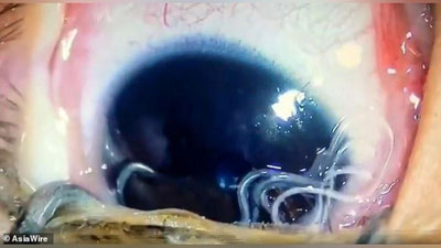 'Xitoylik vrachlar besh oylik go`dakning ko`zlaridan 11 ta tirik parazitlarni olib tashlashdi 'ning rasmi