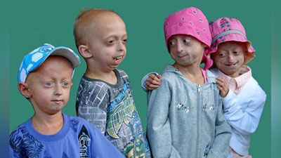 'Олимлар Хатчинсон-Гилфорд синдроми касаллиги бўйича хулосага келди'ning rasmi