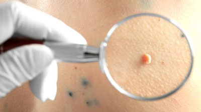 'Одам папиллома вирусининг 13 тури саратон касаллигини келтириб чиқаради'ning rasmi