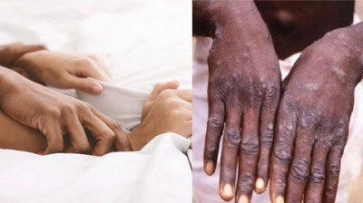 'Иситма, кучли оғриқ, тошмалар...  Ўзбекистон билан чегарадош ҳудудда маймунчечак аниқланди'ning rasmi