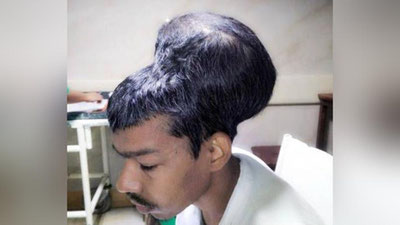 'Ҳинд жарроҳлари дунёдаги энг катта мия ўсимтасини олиб ташлашди'ning rasmi