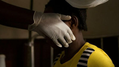 'Маймун чечаги дунёнинг 89 давлатида рўйхатга олинди, беморлар сони қарийб 28 минг нафарга етди — ЖССТ'ning rasmi