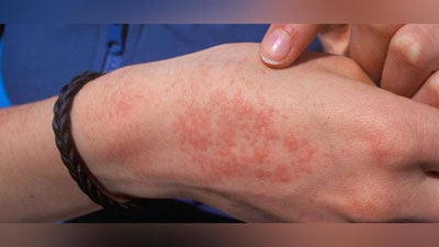 'Oklaxomalik qizda sovuqqa kuchli allergiya borligi aniqlandi 'ning rasmi