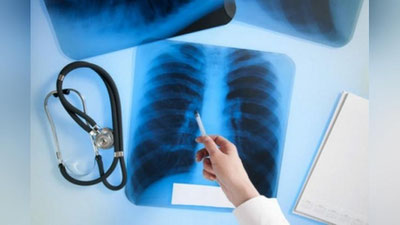 'ЖССТ сил касаллигини аниқлаш ҳамда даволашга доир янги тавсияларини эълон қилди'ning rasmi