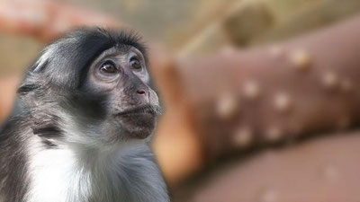 'Маймунчечак қай тарзда юқиши маълум бўлди'ning rasmi