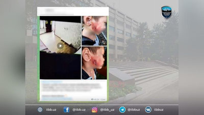 Изрображение 'В Ташкенте 3-летний ребенок получил химический ожог на лице в детсаду'