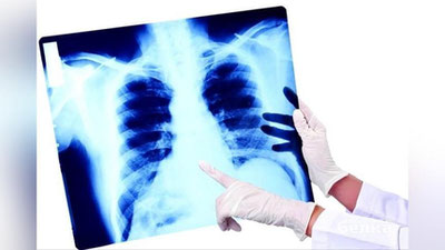 'Kecha 244 nafar kishida pnevmoniya aniqlandi'ning rasmi