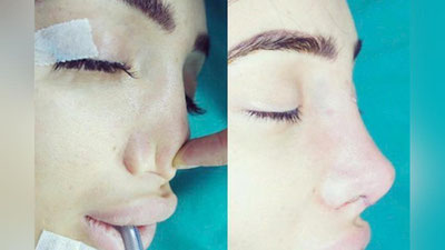 'Модель қиз муваффақиятсиз ринопластика оқибатида бурнидан айрилди'ning rasmi