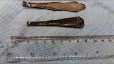 '​Қозоғистонлик шифокорлар бемор йигитнинг ошқозонидан иккита қошиқ дастасини олди'ning rasmi