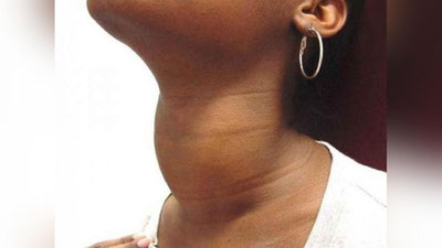 'O`zbekistonda qanday endokrin kasalliklar ko`p uchramoqda?'ning rasmi