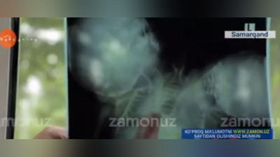 Изрображение 'Родители сиамских близнецов в Самарканде отказались от младенцев?'