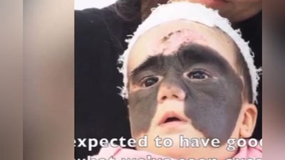 Изрображение 'Мать «девочки-бэтмена» показала дочь после операции (видео)'