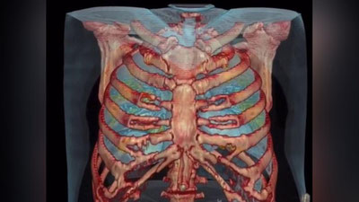 Изрображение 'Американские врачи показали, как коронавирус поражает легкие человека (видео)'