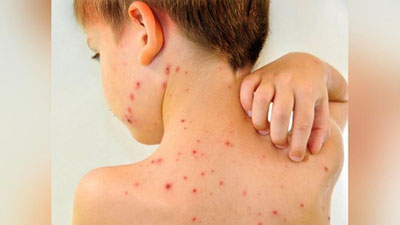 '⚡Xorijdan kelgan qizamiq bilan kasallanganlar bilan aloqada bo`lgan fuqarolarda qizamiq kasalligi aniqlanmoqda'ning rasmi