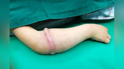'4 ёшли қизчанинг қўл терисига сингиб кетган резинка операция орқали олинди'ning rasmi