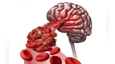 'Koronavirus asoratida bosh miyada tromb hosil bo`lsa, davolash mumkinmi?'ning rasmi