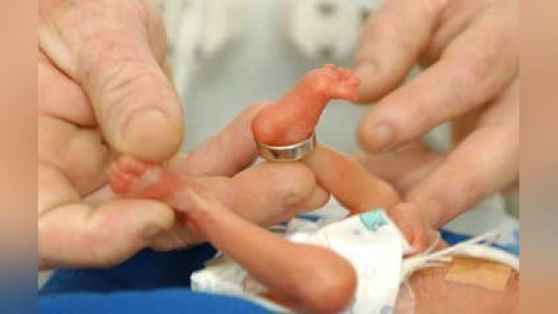 'Toshkentda homiladorlikning 25-haftasida 480 gramm vaznda tug`ilgan chaqaloq 2 yoshga to`ldi'ning rasmi