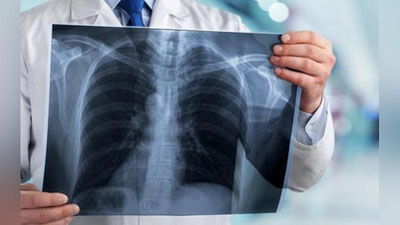 'Pnevmoniyada o`pka 10 foiz yallig`langanda antibiotiklarsiz davolash mumkinmi?'ning rasmi