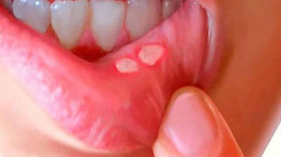 'Dunyo aholisining qariyb yarmi og`iz bo`shlig`i kasalliklaridan aziyat chekmoqda - JSST'ning rasmi